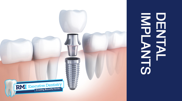 Dental Implants